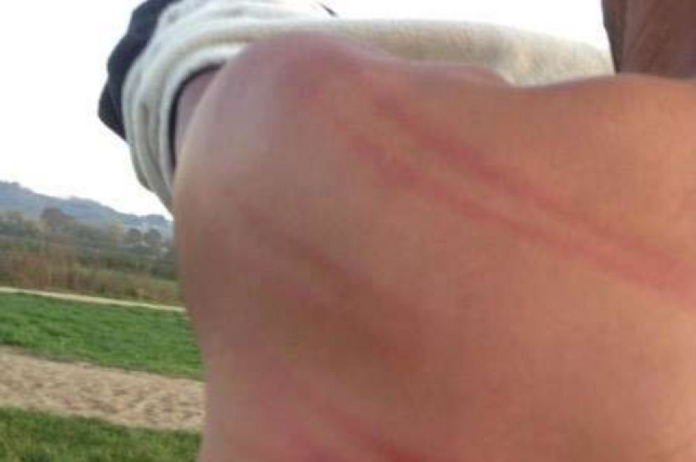 Lividi, graffi e bruciature sui corpi dei migranti provocati da bastonate e "lezioncine" (Borderviolence.eu)