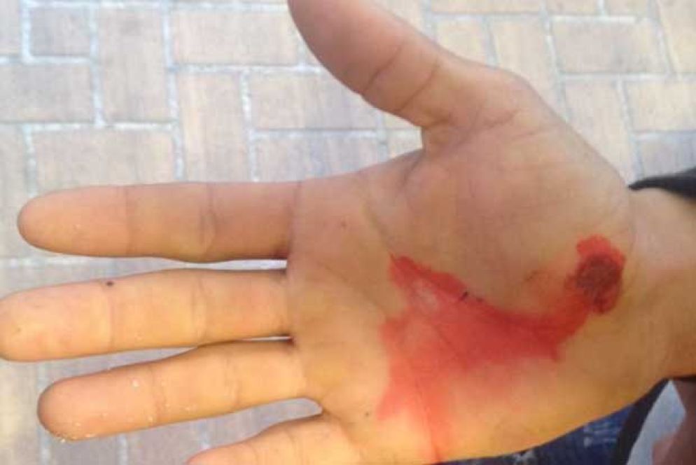 La ferita provocata dal morso di un cane sulla mano di Ahmed