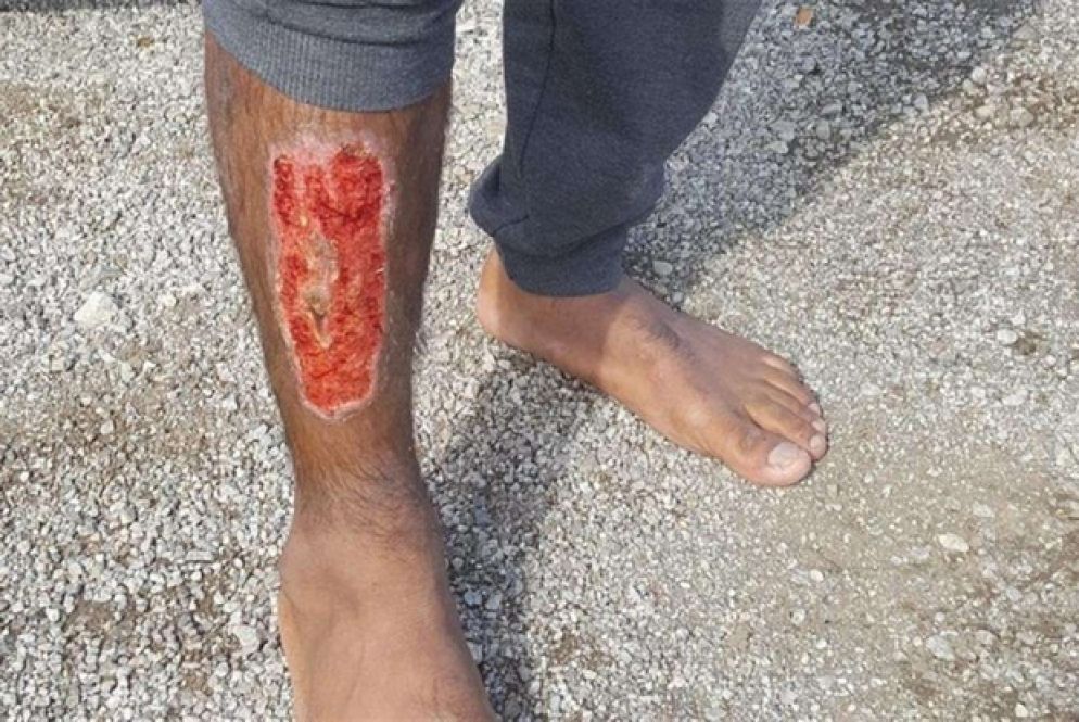 Lividi, graffi e bruciature sui corpi dei migranti provocati da bastonate e "lezioncine" (Borderviolence.eu)