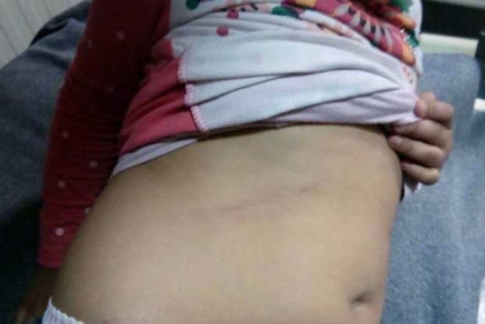 Il segno della manganellata sul corpo della bambina