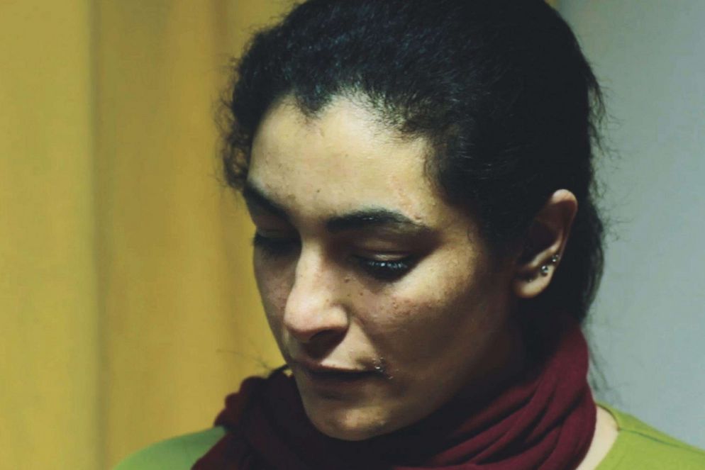 Rasha, profuga in Siria, è stata ferita agli occhi dalle schegge di una bomba