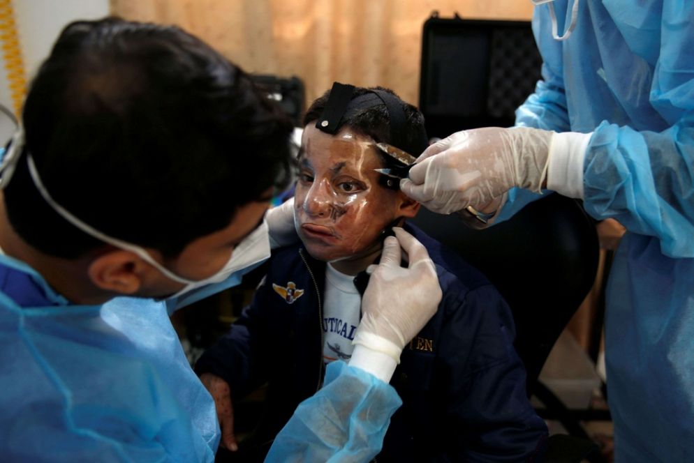 Gli ultimi aggiustamenti alla maschera terapeutica nella clinica di Gaza - Reuters